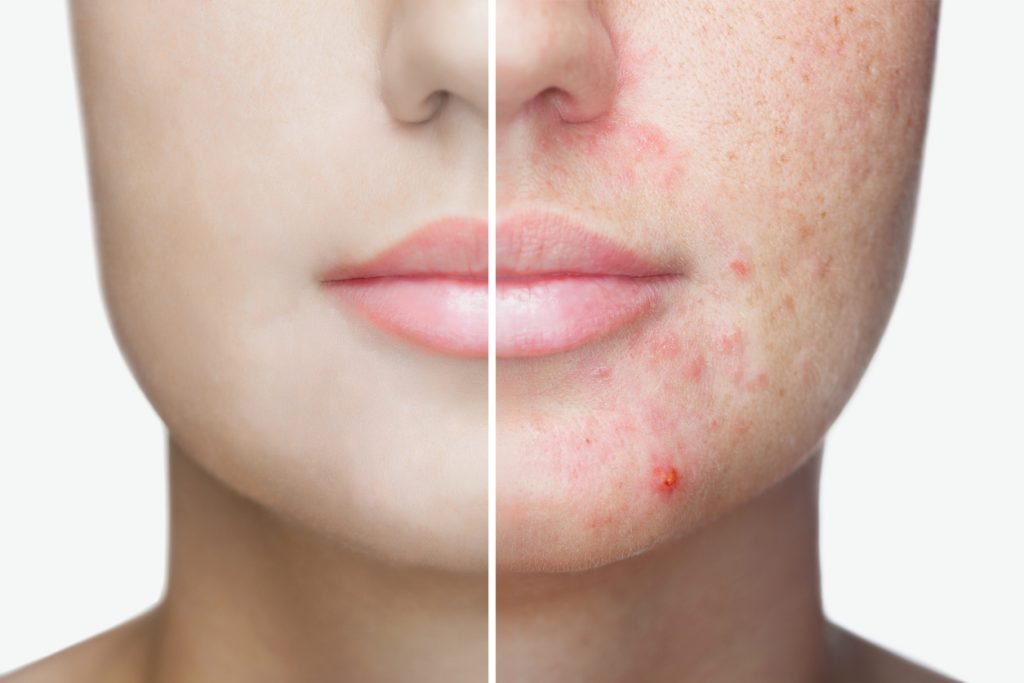 Before And After Acne Photo